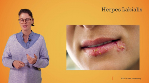 Video SOA's: herpes - Personenzorg 2de graad