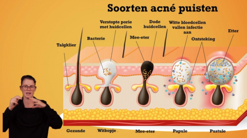 Video Gelaatsverzorging: acne of puisten - Personenzorg 2de graad