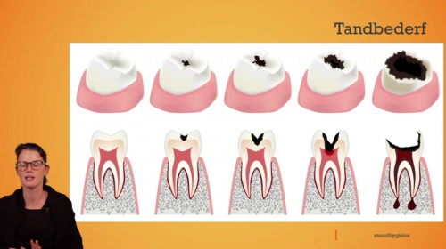 Video Mondhygiëne: tandbederf -  1ste graad A