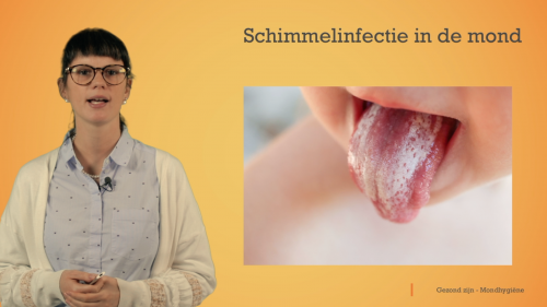 Video Mondhygiëne: infecties in de mond -  1ste graad A