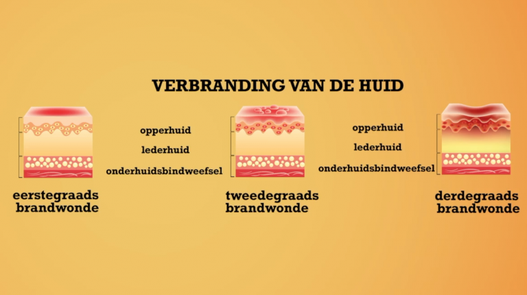 EHBO: brandwonde & verbranding van de huid